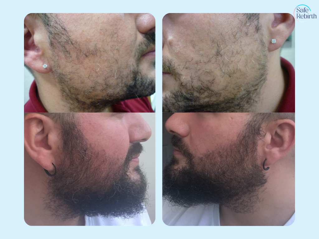 Beard Implant