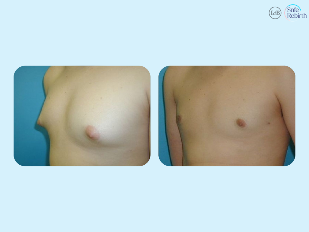 Mastectomy 1png