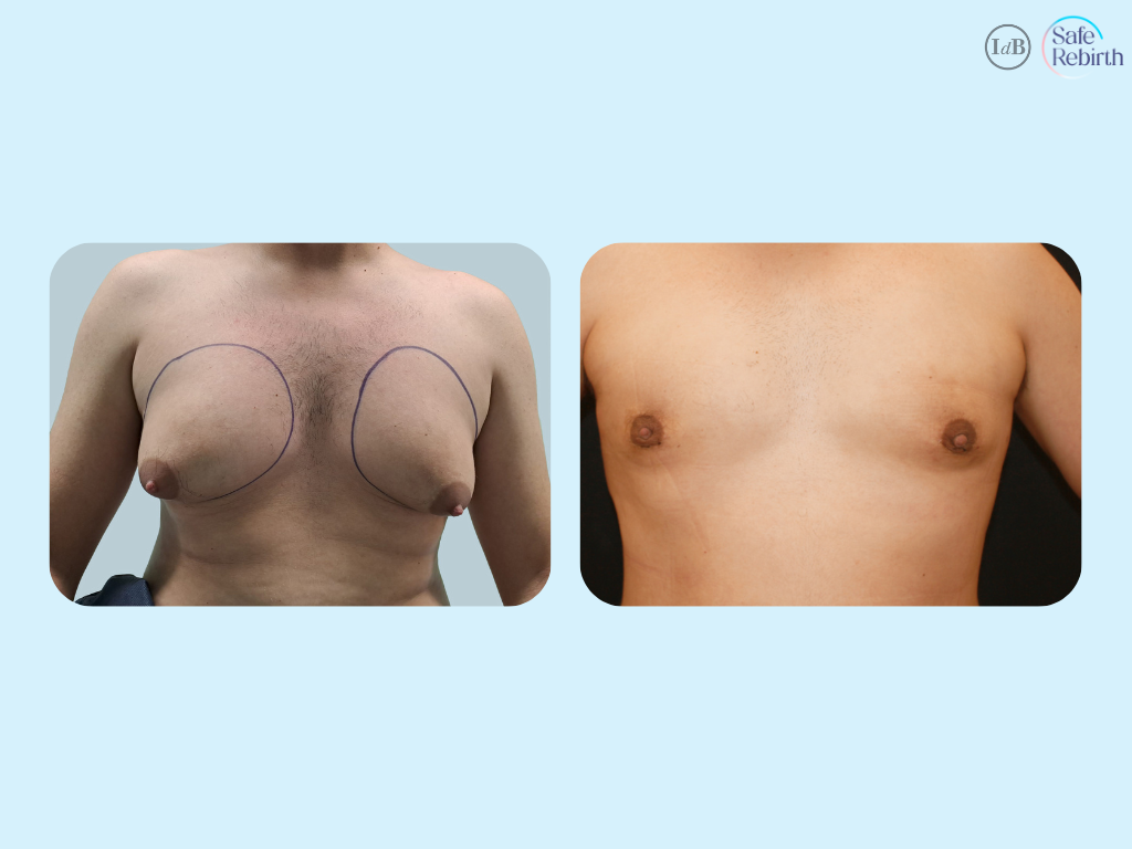 Mastectomy2