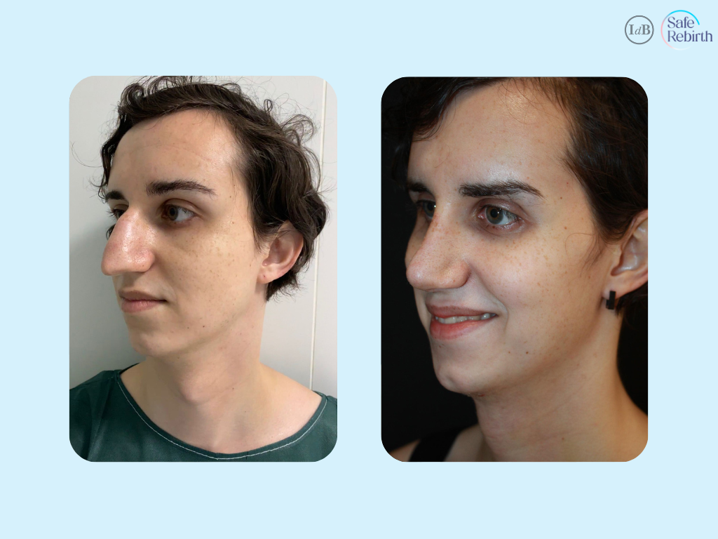 Rhinoplasty + Genioplasty2