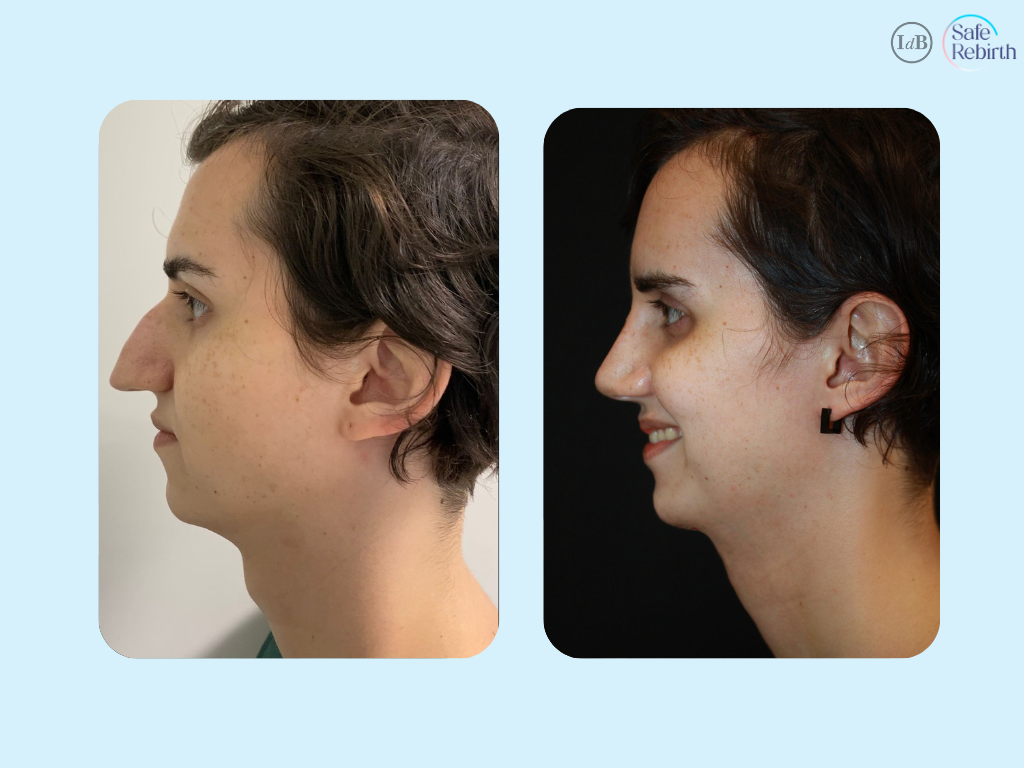 Rhinoplasty & genioplasty 3