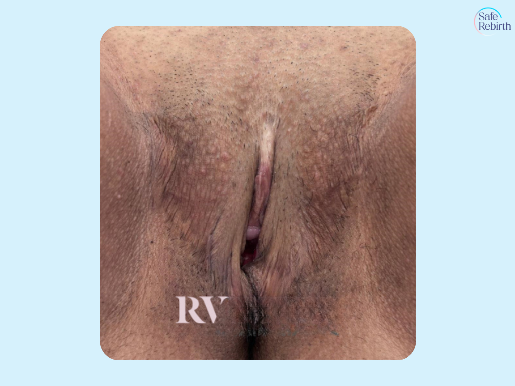 Vaginoplasty2