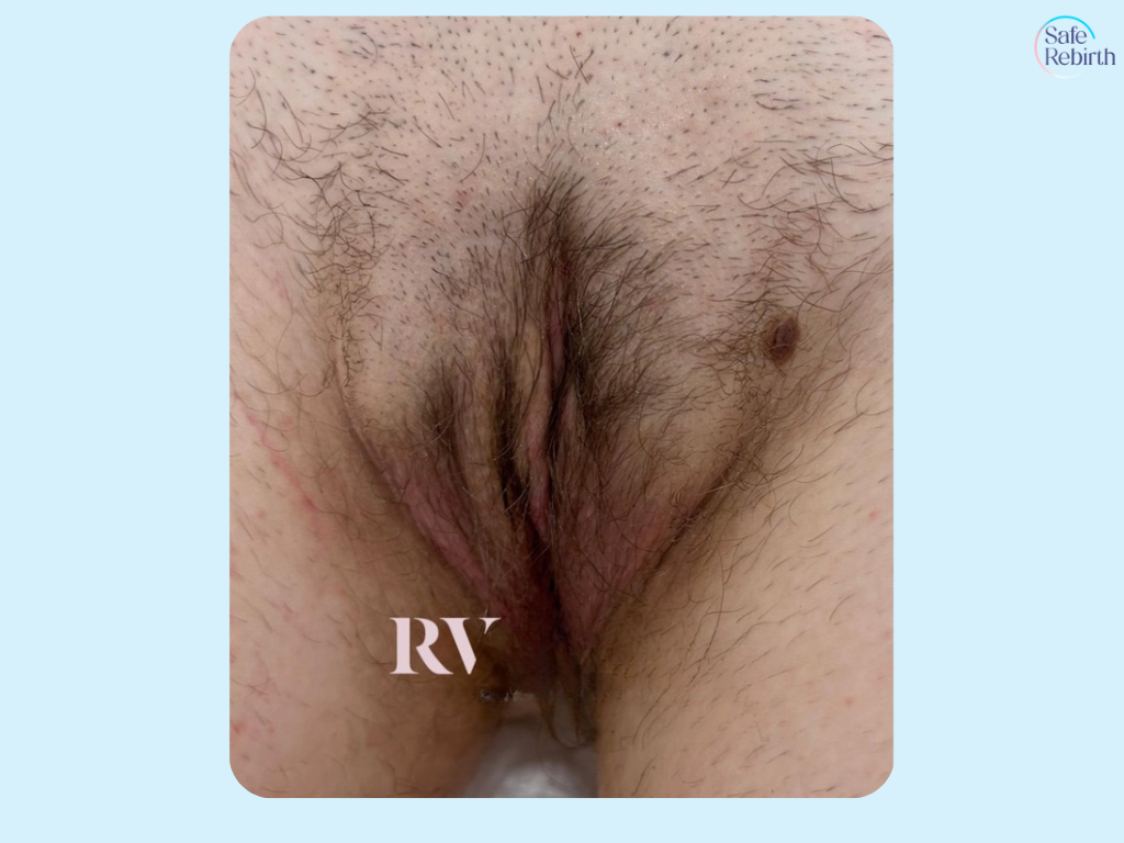 Vaginoplasty4