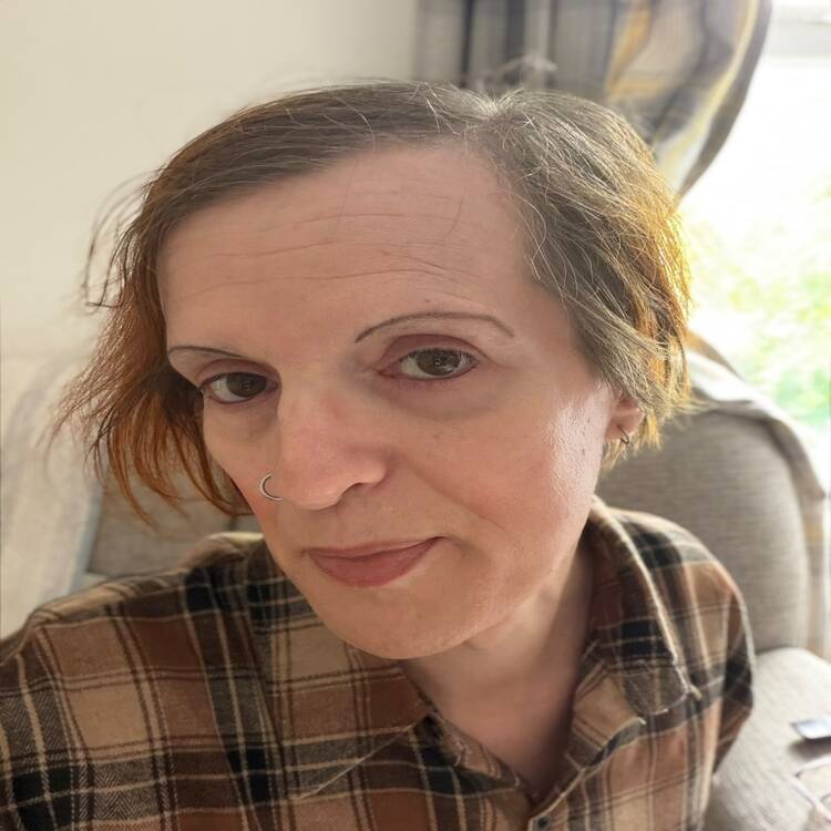 Chin Reduction After Result