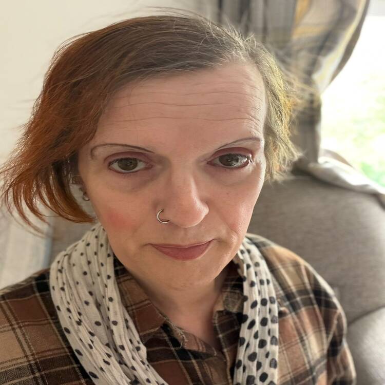 Genioplasty After Result